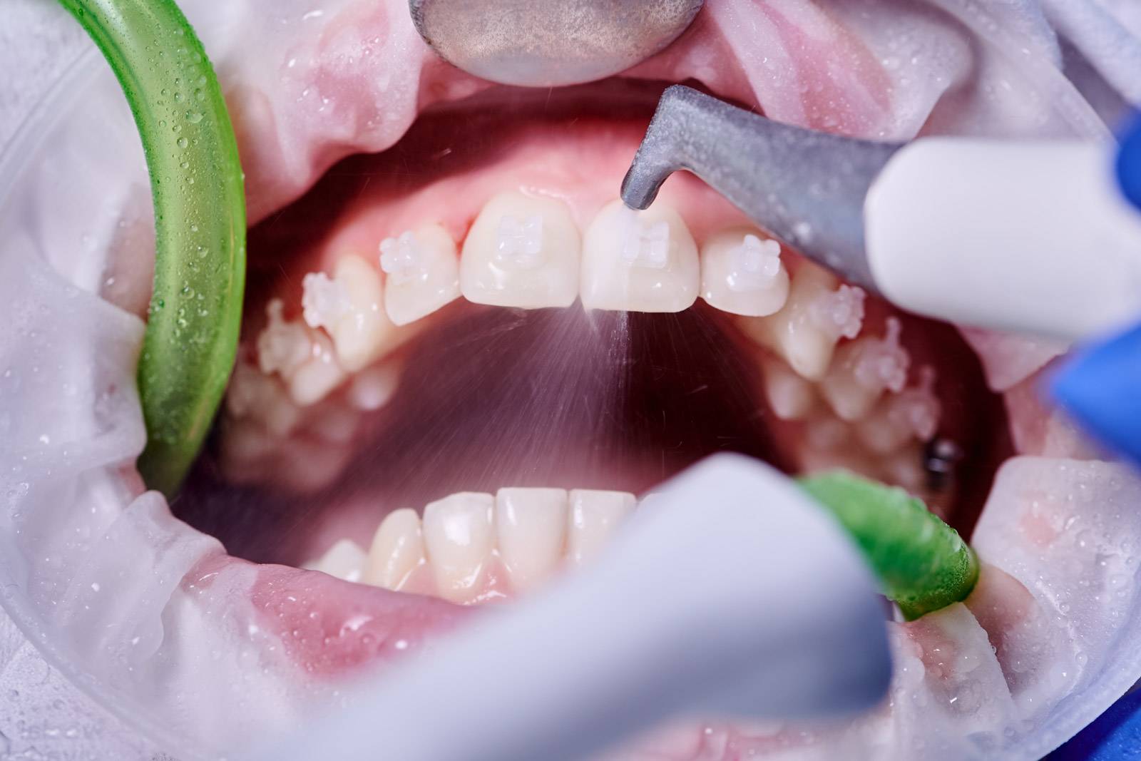 blog pulizia dentale