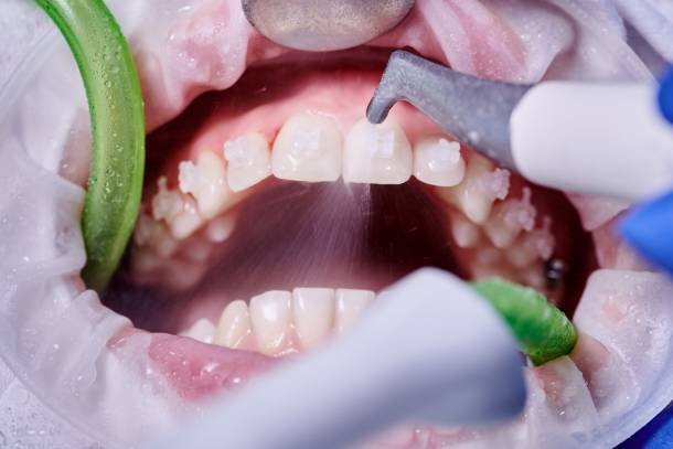 blog pulizia dentale