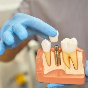 denti sensibili