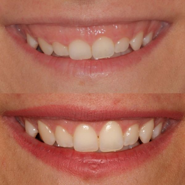 Gummy smile chirurgia plastica parodontale per trattare eruzione passiva alterata