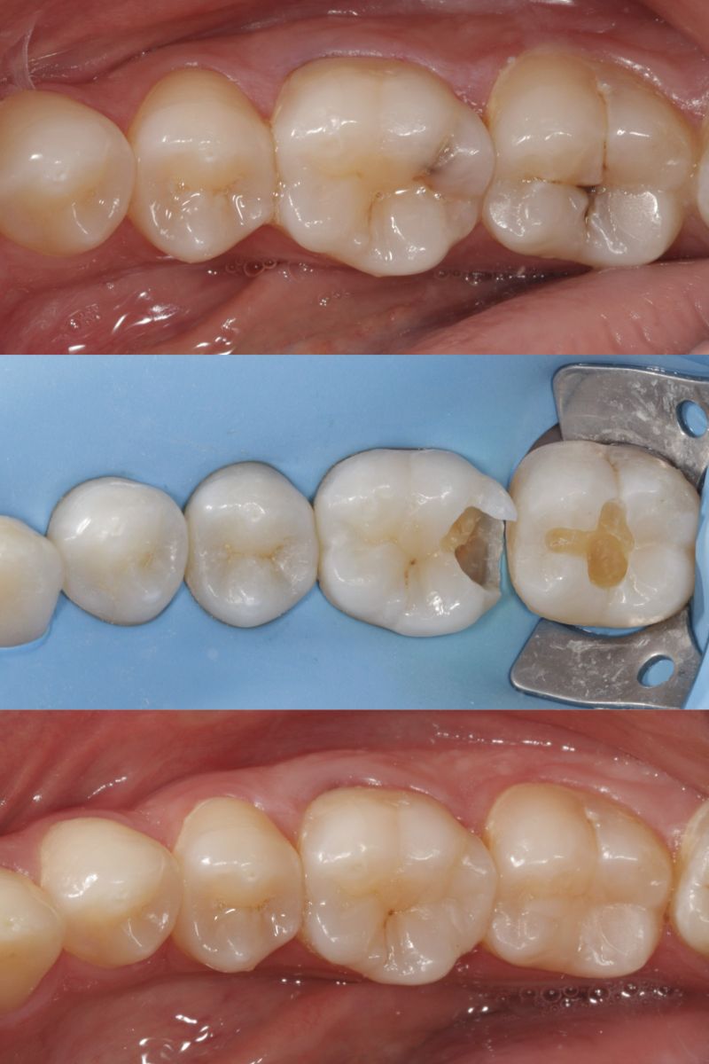 Conservativa pulizia carie e ricostruzioni estetiche posteriori dirette in composito
