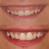 wp-content/uploads/2024/08/caso-studio_gummy-smile-01.jpg