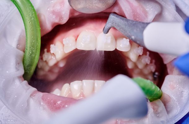 blog pulizia dentale